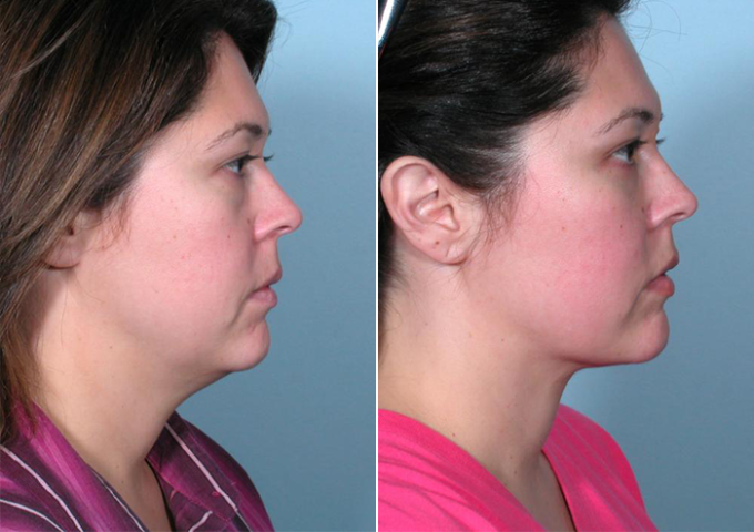 Discover Mini Neck Lifts Nearby: Enhance Your Jawline post thumbnail image